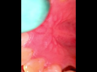 Inside my mouth (with braces)